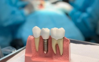 Implante dentário – seu novo sorriso