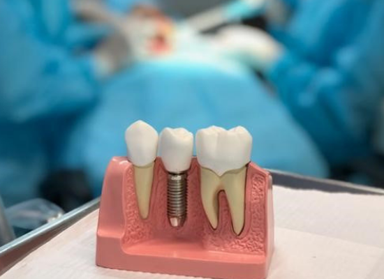 Implante dentário – seu novo sorriso